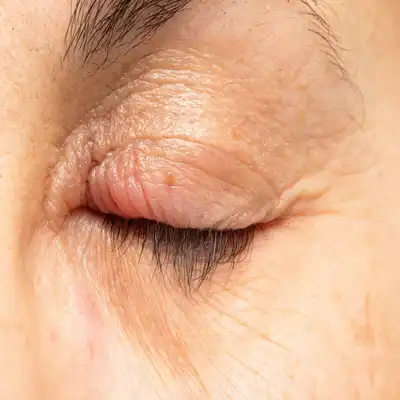 7 Home Remedies for Getting Rid of a Stye